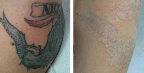 Tattoo Removal before after 3
