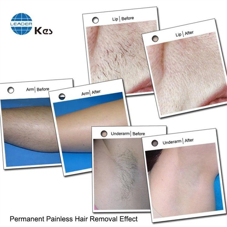 808nm Diode Laser Hair Removal Machine